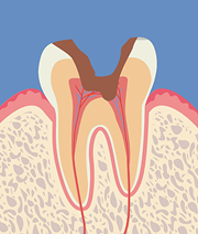 【C3】神経まで達した虫歯