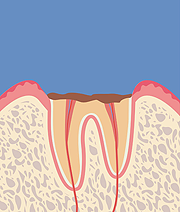 【C4】歯の根まで進行した虫歯