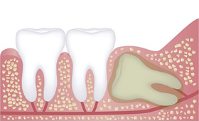 完全に埋まっている親知らずの歯