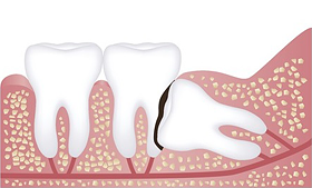 斜めに埋まっている親知らずの歯