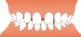 空隙歯列（すきっ歯）