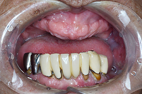 上は歯がなく、下の前歯は歯周病の状態